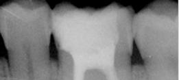 http://dr-diss-antoine.chirurgiens-dentistes.fr/dentiste/cms/upload/2_source/fiche/endo01.jpg