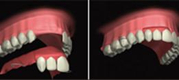 http://dr-diss-antoine.chirurgiens-dentistes.fr/dentiste/cms/upload/2_source/fiche/prot-partiel2.jpg