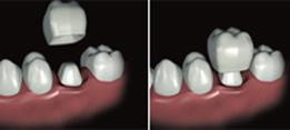 http://dr-diss-antoine.chirurgiens-dentistes.fr/dentiste/cms/upload/2_source/fiche/prot-provisoire.jpg