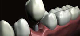 http://dr-diss-antoine.chirurgiens-dentistes.fr/dentiste/cms/upload/2_source/fiche/prot-impla.jpg