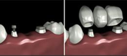 http://dr-diss-antoine.chirurgiens-dentistes.fr/dentiste/cms/upload/2_source/fiche/bridge-32.jpg