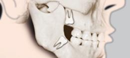 http://dr-diss-antoine.chirurgiens-dentistes.fr/dentiste/cms/upload/2_source/fiche/dent-sagesse23.jpg