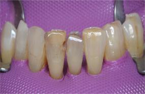 http://dr-diss-antoine.chirurgiens-dentistes.fr/dentiste/cms/upload/59_docteur-diss/fiche/adhesif_01.jpg