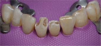 http://dr-diss-antoine.chirurgiens-dentistes.fr/dentiste/cms/upload/59_docteur-diss/fiche/adhesif02.jpg