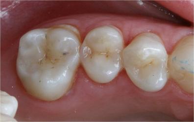 http://dr-diss-antoine.chirurgiens-dentistes.fr/dentiste/cms/upload/59_docteur-diss/fiche/posterieur02.jpg