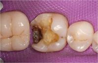 http://dr-diss-antoine.chirurgiens-dentistes.fr/dentiste/cms/upload/59_docteur-diss/fiche/posterieur04.jpg