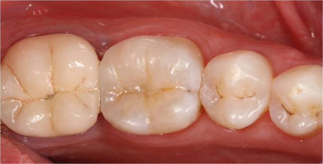 http://dr-diss-antoine.chirurgiens-dentistes.fr/dentiste/cms/upload/59_docteur-diss/fiche/posterieur06.jpg