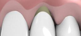 http://dr-diss-antoine.chirurgiens-dentistes.fr/dentiste/cms/upload/2_source/fiche/vignette3.jpg