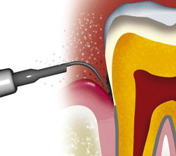 http://dr-diss-antoine.chirurgiens-dentistes.fr/dentiste/cms/upload/59_docteur-diss/fiche/etape3_brumisateur(2).gif