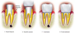 http://dr-diss-antoine.chirurgiens-dentistes.fr/dentiste/cms/upload/2_source/fiche/vign-couronne_carie2.jpg