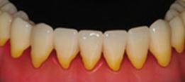 http://dr-diss-antoine.chirurgiens-dentistes.fr/dentiste/cms/upload/2_source/fiche/plaque-dentaire-a.jpg