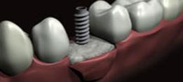 http://dr-diss-antoine.chirurgiens-dentistes.fr/dentiste/cms/upload/59_docteur-diss/fiche/implant_pose.jpg