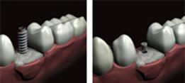 http://dr-diss-antoine.chirurgiens-dentistes.fr/dentiste/cms/upload/59_docteur-diss/fiche/pose-implant.jpg