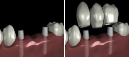 http://dr-diss-antoine.chirurgiens-dentistes.fr/dentiste/cms/upload/59_docteur-diss/fiche/prothese-implant.jpg
