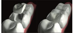 http://dr-diss-antoine.chirurgiens-dentistes.fr/dentiste/cms/upload/2_source/fiche/tec-indirecte.jpg