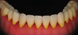 http://dr-diss-antoine.chirurgiens-dentistes.fr/dentiste/cms/upload/59_docteur-diss/fiche/gingivite.jpg