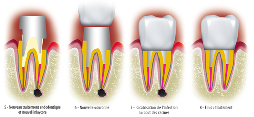 http://dr-diss-antoine.chirurgiens-dentistes.fr/dentiste/cms/upload/59_docteur-diss/fiche/couronne_carie2(2).jpg