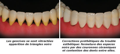 http://dr-diss-antoine.chirurgiens-dentistes.fr/dentiste/cms/upload/59_docteur-diss/fiche/gencives-retractees-2-c.jpg