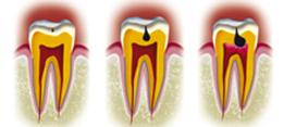 http://dr-diss-antoine.chirurgiens-dentistes.fr/dentiste/cms/upload/2_source/fiche/diferent-type.jpg
