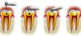 http://dr-diss-antoine.chirurgiens-dentistes.fr/dentiste/cms/upload/2_source/fiche/soigner-carie.jpg