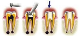 http://dr-diss-antoine.chirurgiens-dentistes.fr/dentiste/cms/upload/2_source/fiche/devitalization1.jpg