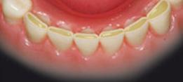 http://dr-diss-antoine.chirurgiens-dentistes.fr/dentiste/cms/upload/2_source/fiche/bruxisme.jpg