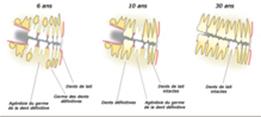 http://dr-diss-antoine.chirurgiens-dentistes.fr/dentiste/cms/upload/2_source/fiche/agenesie23.jpg