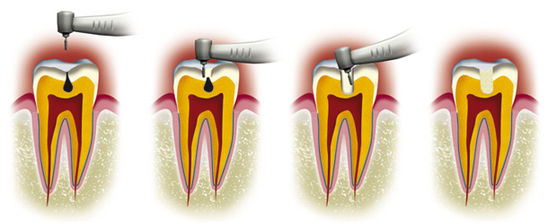 http://dr-diss-antoine.chirurgiens-dentistes.fr/dentiste/cms/upload/59_docteur-diss/fiche/soin-carie.jpg